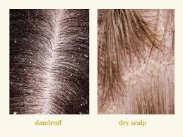 The symptoms can be different degrees. Dandruff Vs Dry Scalp Causes Symptoms And Best Treatments