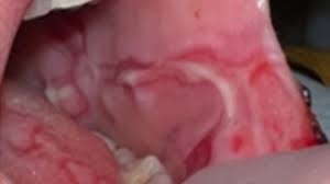 Image result for Erythema Multiforme Major