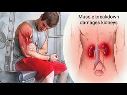 نتیجه تصویری برای ‪Rhabdomyolysis‬‏