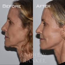 Andrew S. Frankel, MD, FACS (@drandrewfrankel) • Instagram photos and videos