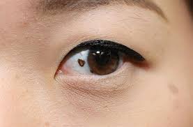 Image result for nevus sclerae