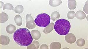 Leucemia linfocítica aguda (lla) para usar las funciones de compartir de esta páginas, por favor, habilite javascript. Nueva Terapia T Car Capaz De Curar La Leucemia Linfoblastica Aguda En Ninos Y Jovenes