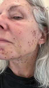 Faces of Neurofibromatosis