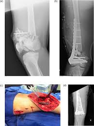 Image result for Open Fracture