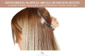 Image result for Alopecia