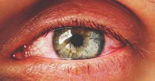Image result for Allergic Conjunctivitis