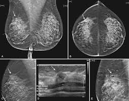 Image result for Mammogram Interpretation