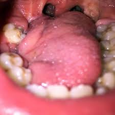 Image result for spinocellular carcinoma of the oral cavity