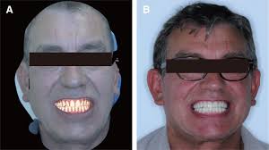 Integrating 3D facial scanning in a digital workflow to CAD/CAM design and  fabricate complete dentures for immediate total mouth rehabilitation.