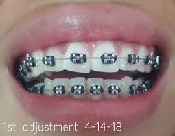 Black And White Braces For Teeth Ma Deuxieme Couleur De Groupes Et J Etais Vraiment Excitee J Ai Deja Dans Mon Esprit Pour Obtenir My Brace Journey Cute Braces Braces Colors Dental Braces