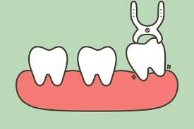 Having wisdom teeth pulled from the very. How Long Should I Wait To Eat After Wisdom Teeth Extraction
