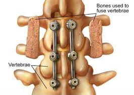 I Was On A Popular Spine Health Forum Talking With A Few People About Spinal Fusion And Reading Some Of The A Spinal Fusion Spinal Fusion Surgery Spine Surgery