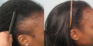 Some black men will have extremely curly hair that it may be very difficult or even impossible to use fue. African American Hair Transplant