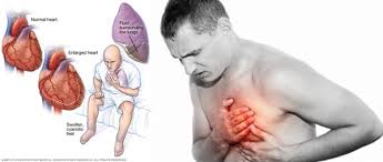 Kendati demikian, tidak semua orang yang mengalami kelelahan atau gangguan tidur sudah pasti akan terkena serangan jantung. Berikut Tanda Tanda Serangan Jantung Khsblog D