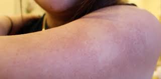 It is possible that acne may not be the source of skin woes. How To Get Rid Of Those Acne Bumps On Your Skin Naturally Keratosis Pilaris Easy Life Hacks