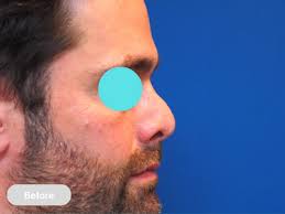 Brisbane Rhinoplasty