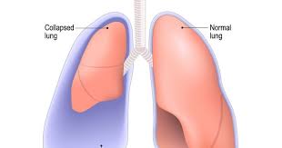 Image result for Pneumothorax
