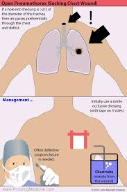 Image result for Open Pneumothorax