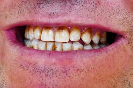 Image result for Tooth Discoloration