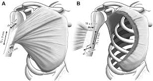 Tendonitis is when a tendon swells (becomes inflamed) after a tendon injury. Schematic Morphology Of The Pectoralis Major Pm Tendon A With The Download Scientific Diagram