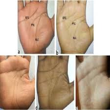 Check spelling or type a new query. Pdf The Simian Crease A Significant Phenotypic Indices Of Palmar Dermatoglyphics Among Bangladeshi Down Syndrome Patient