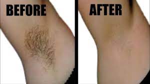 Armpit Hair Is An Annoying Thins Especially For Women Thus They All Trying To Get Rid Of Them Underarm Hair Anti Aging Skin Care Remedies Remove Armpit Hair