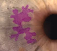 We did not find results for: Cornea Louisville Ocular Herpes Louisville Bennett Bloom