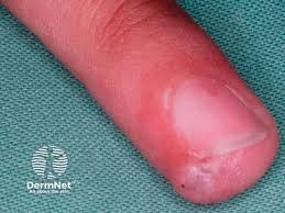 Image result for Glomus tumor