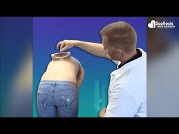 Scoliosis that starts later in life is usually because of wear and tear and often can cause pain and nerve pressure. 5 Easy Ways To Know If You Ll Have Scoliosis Youtube