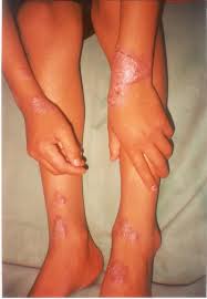 Lupus is a prototypic autoimmune disease that occurs when the body's immune system attacks its own tissues and organs. Indian Pediatrics Editorial