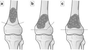 Include the vertebrae, sacrum, coccyx, and hyoid bone. Growth Of Epiphysis After Epiphyseal Preservation Surgery For Childhood Osteosarcoma Around The Knee Joint Bmc Musculoskeletal Disorders Full Text