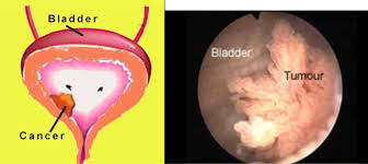 The average age people are diagnosed with bladder cancer is 73. Bladder Cancer Chin Chong Min Urology Robotic Surgery Centre