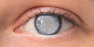 A cataract can occur in either or both eyes. Cortical Cataracts Symptoms Causes And Treatment Neoretina Blog