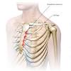 Costochondritis is an inflammation of the cartilage in the rib cage. 1