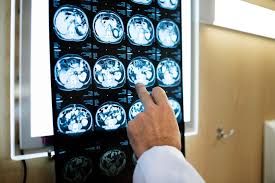 Métodos foram incluídos no estudo os pacientes rotura de aneurisma cerebral submetidos a tratamento em nosso serviço de neuroci Tomografia Computadorizada O Que E O Exame Tc Delboni Auriemo