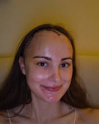 Fundraiser by Kirsty Guldbrandsen : Support Kirsty's Recovery After Brain  Tumour Surgery