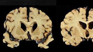 The images in the bottom row are of the brain of former football player greg ploetz, who had severe cte. Yes Aaron Hernandez Suffered Brain Injury But That May Not Explain His Violence The New York Times