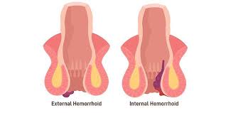 Image result for hemoroid human