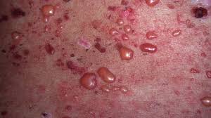 Check spelling or type a new query. Systemic Lupus Erythematosus Causes Symptoms And Treatment