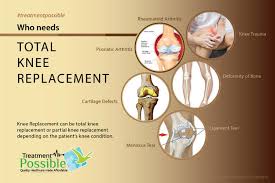 Amyn rajani, a known knee specialist in mumbai. Total Knee Replacement Surgery In India Knee Replacement Cost