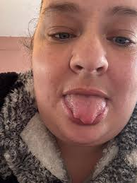 Would everyone mind describing what their tongues look like. My BMS only  started approximately a month ago. I have a red patch about the size of a  raison, its very flat no