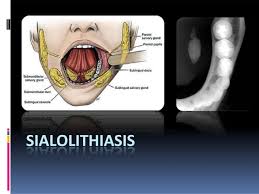 Image result for Sialolithiasis