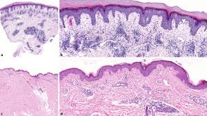 Erleben sie günstige preise und viele kostenlose extras wie proben & zeitschriften. Lupus Erythematodes Ein Klinisch Pathologisch Heterogenes Krankheitsbild Springerlink