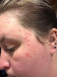 Hi has anyone experienced facial skin rashes after going gluten free?