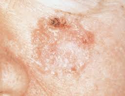 Image result for squamous cell carcinoma skin face
