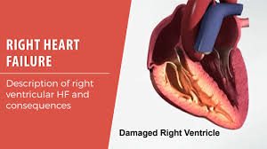 Image result for Right Heart Failure