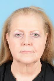 Facelift Before & After Photos