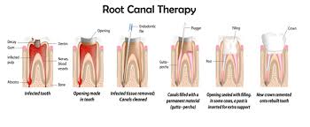 Rarely, there is a real flare up and an emergency visit or a stronger pain killer is needed. What Root Canal Treatment Is Does It Hurt