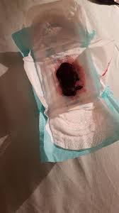 Maybe you would like to learn more about one of these? Miscarriage Or Blood Clot Grief Loss Forums What To Expect