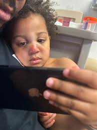 Mothers day was a doozy 😅 Our babygirl, Wild Willow lived up to her name.  Our day was half spent at children's with her BROKEN NOSE 😭 This is the  worst part